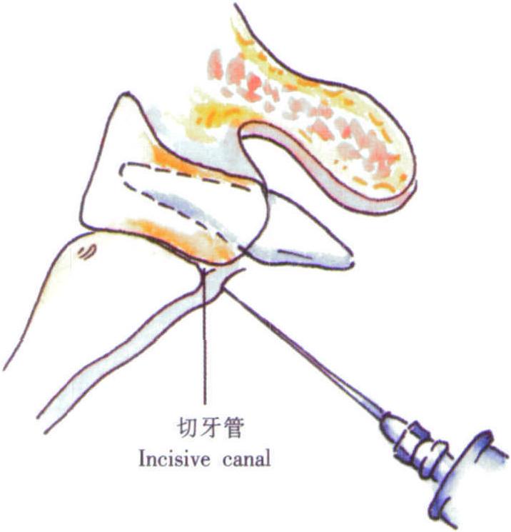 鼻腭神經阻滯麻醉